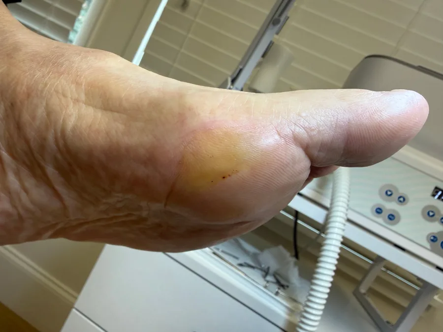 Same area after treatment, callus removed and skin smooth