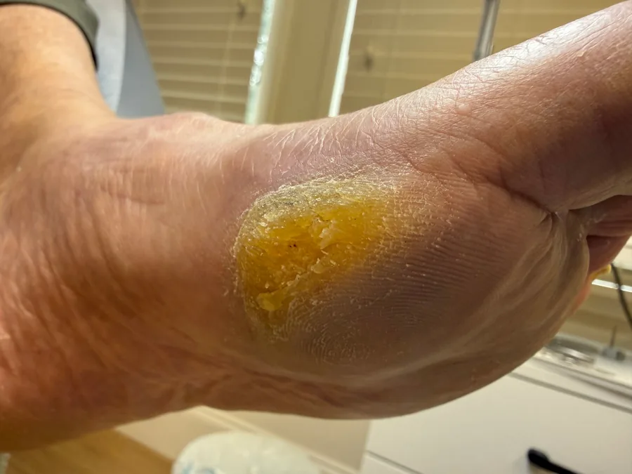 Thick yellow callus under the big toe joint before treatment