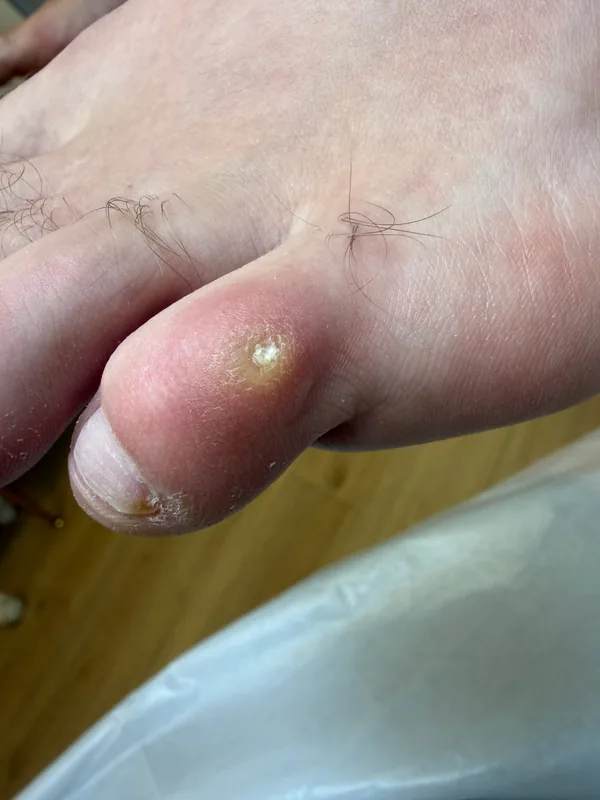 Corn on the side of a toe before treatment