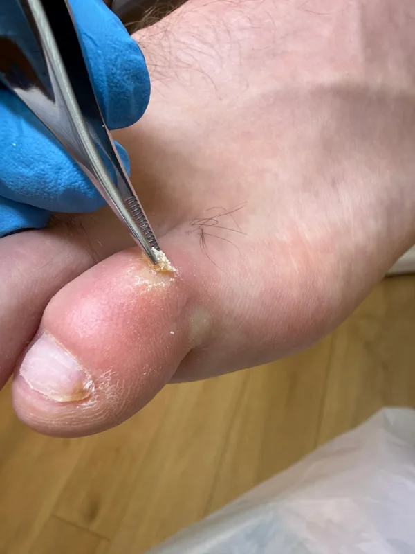 Lifting the core of a corn with fine tweezers