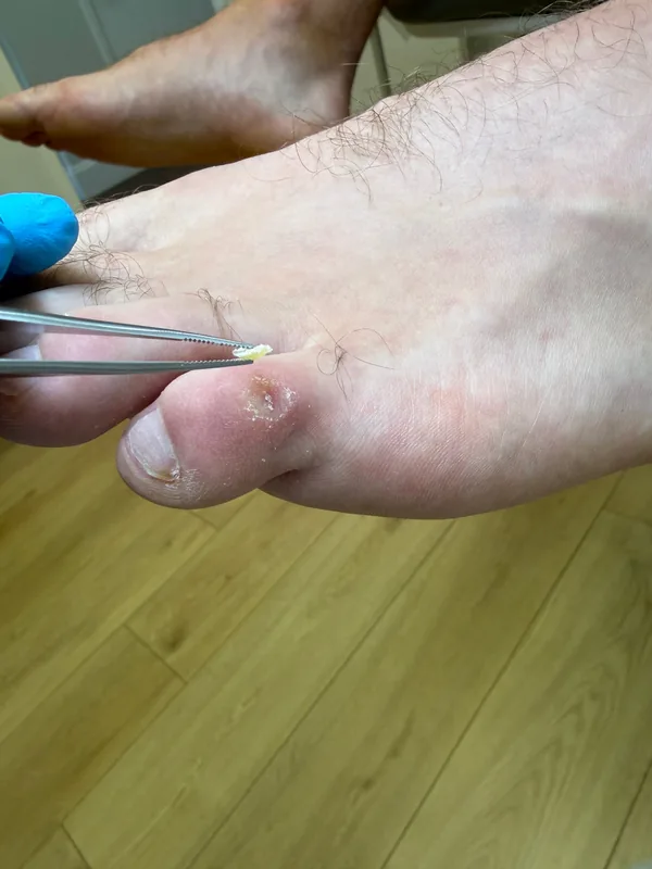 The removed corn core held in tweezers