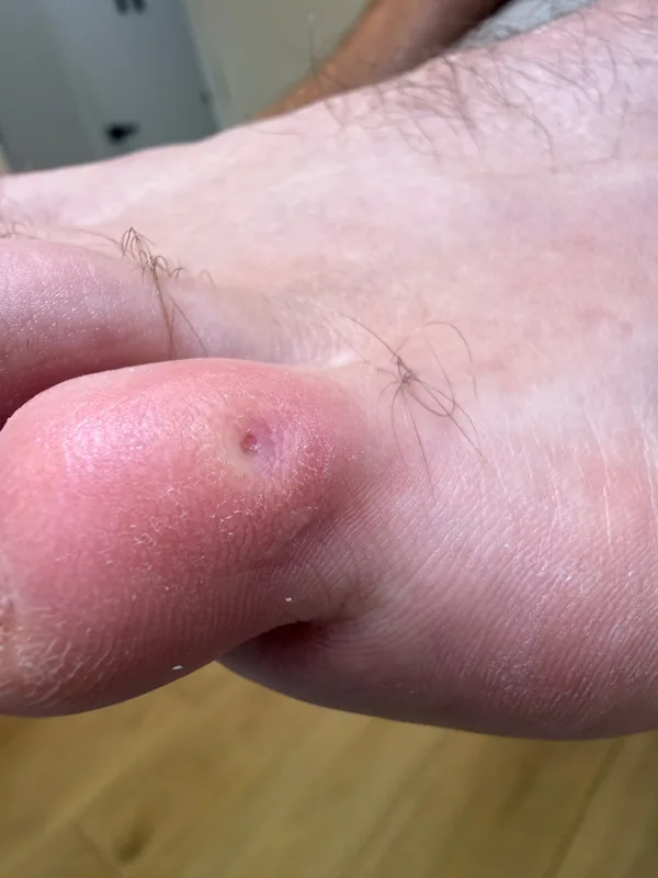 Toe after the corn and its core were removed