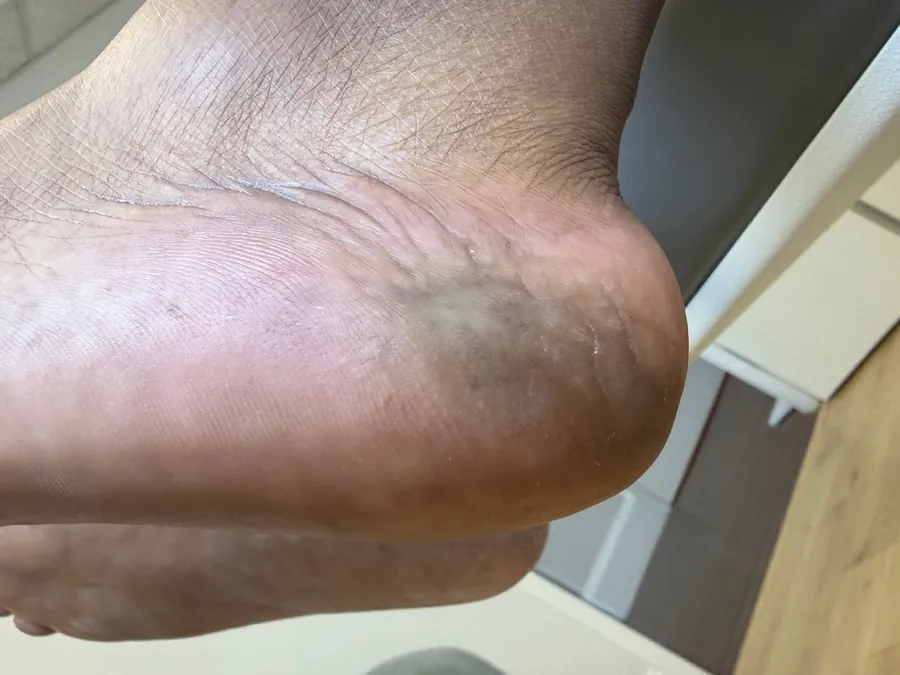 Heel after treatment, smooth and even