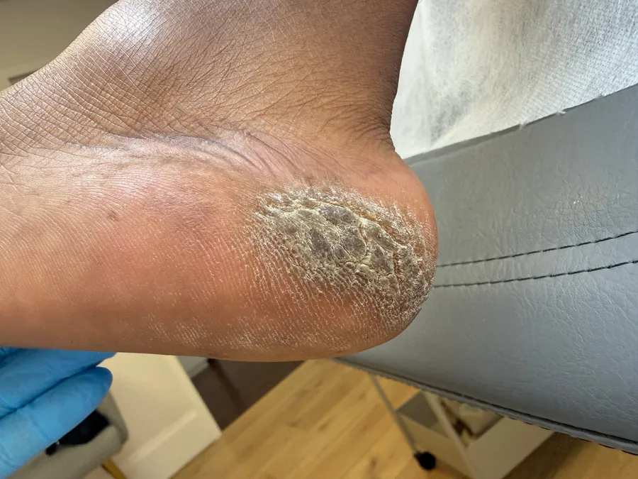 Heel before treatment, with thick, dry, cracked callus
