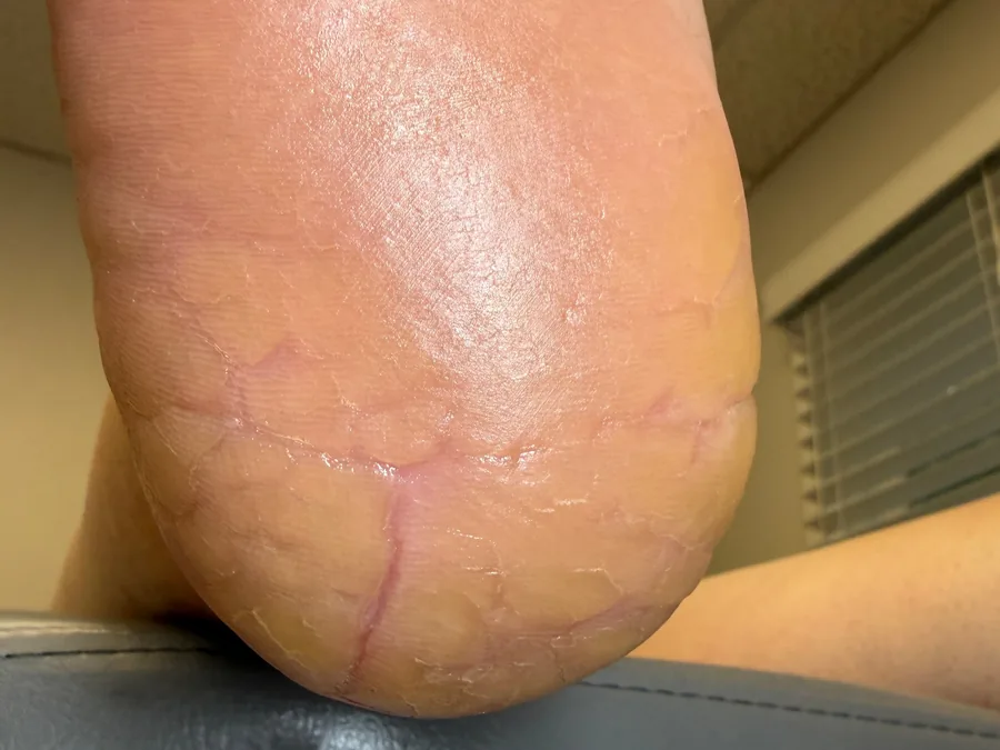 Same heel after treatment, smooth and hydrated with cracks closed