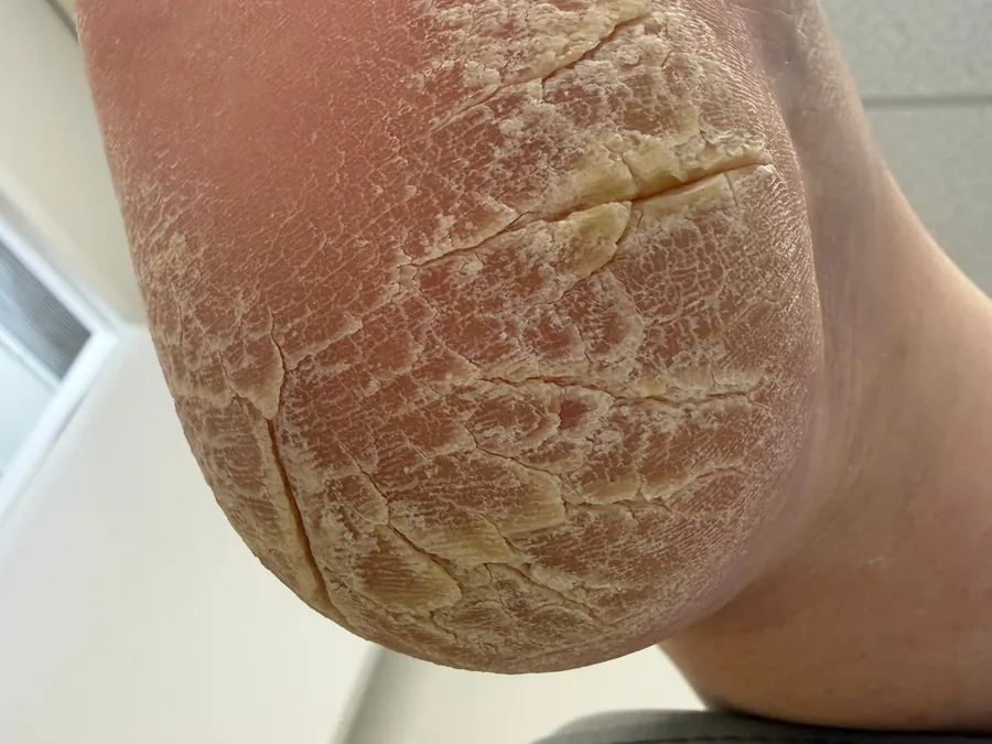 Heel before treatment, very dry with scaly, flaking skin and deep cracks