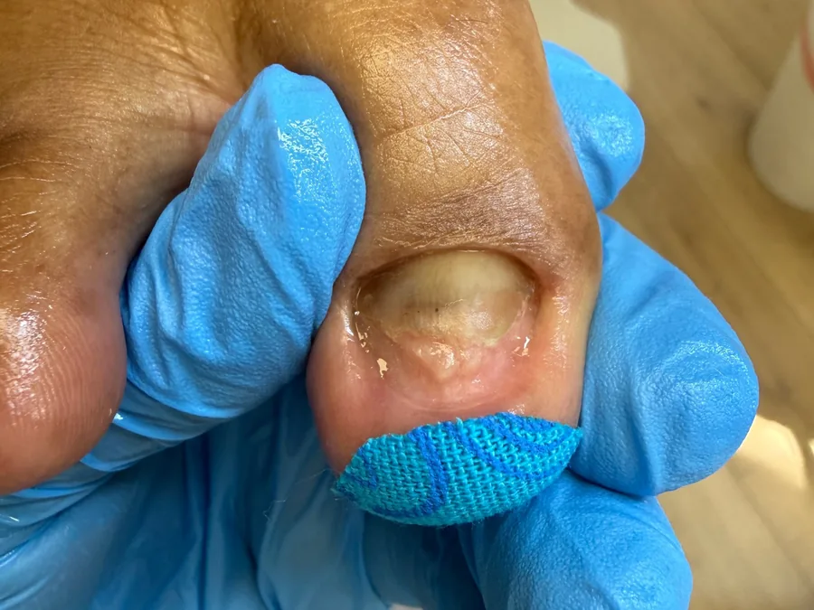 Same toenail after treatment, thinned and smoothed with clean nail folds