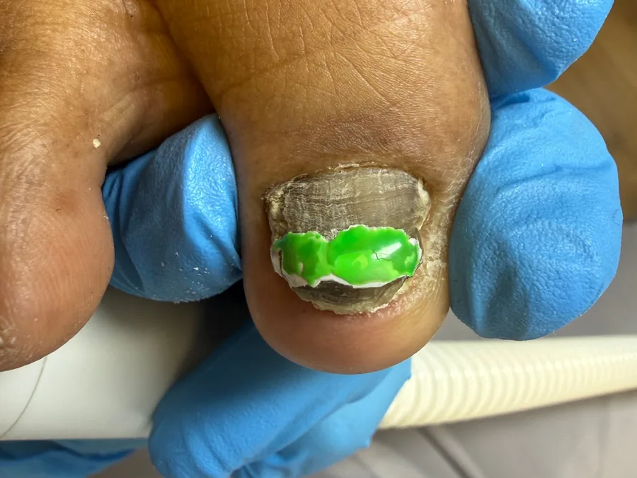 Thick, discolored big toenail with a rough, layered surface before treatment
