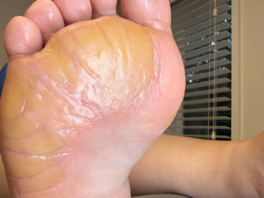 Same foot after treatment, callus reduced and skin smooth