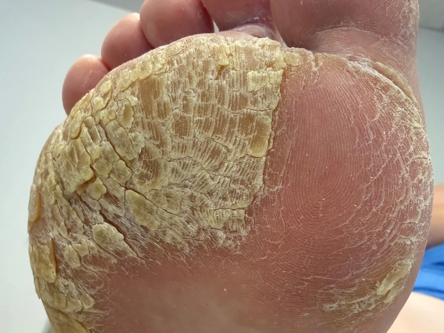 Ball of the foot before treatment, with thick, cracked yellow callus