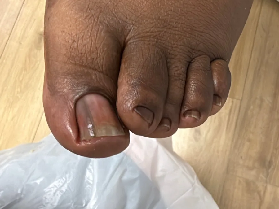 Same toes after treatment, skin smooth and moisturized, cuticles clean