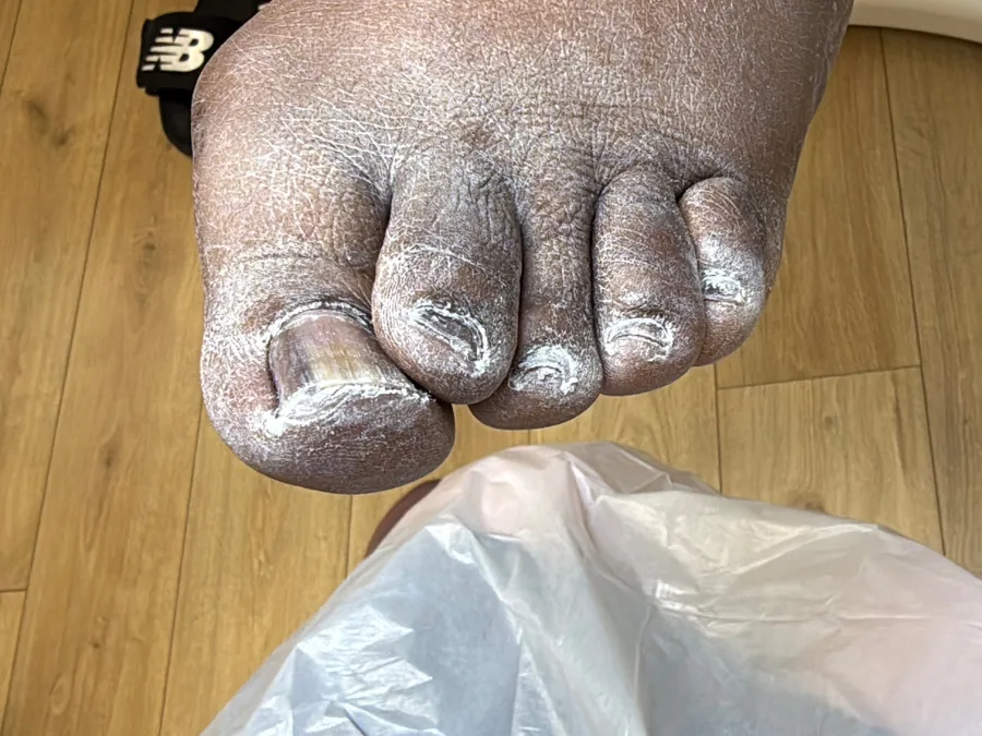 Toes before treatment, with very dry, flaky skin and dry cuticles