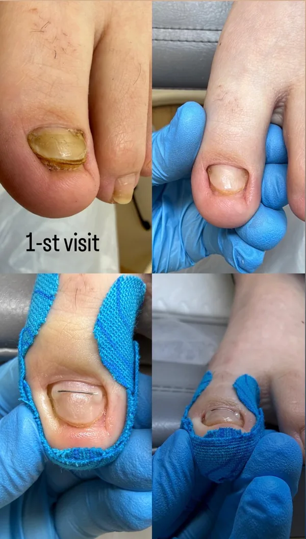 Titanium wire correction, 1st visit: nail before, after preparation, and with the wire fitted under protective tape