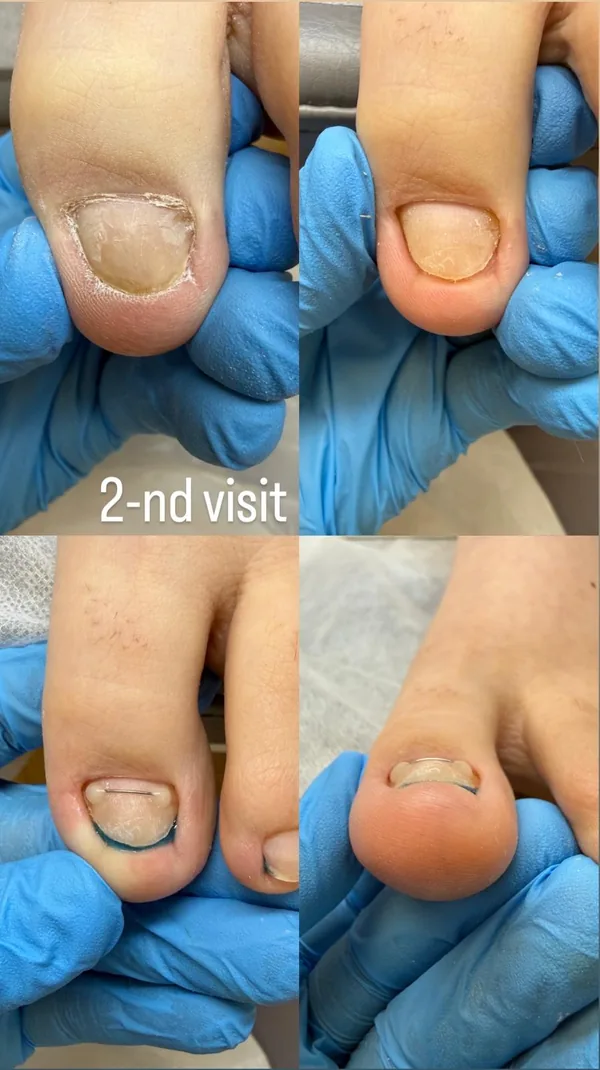 Titanium wire correction, 2nd visit: nail at follow-up, cleaned, and with a new wire applied